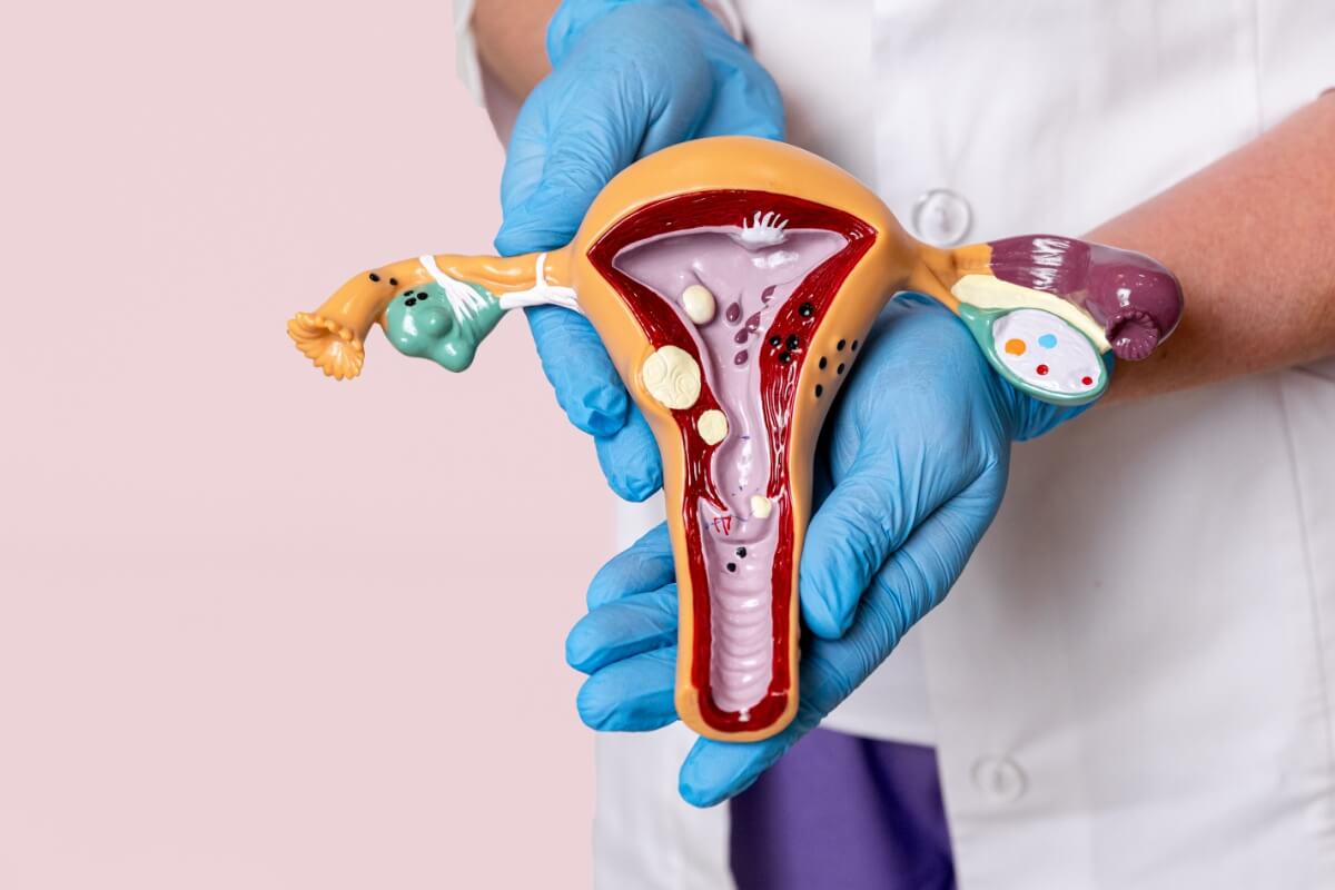 patiente, vous souffrez d'endométriose avec Norm'Endo, filiaire endométriose